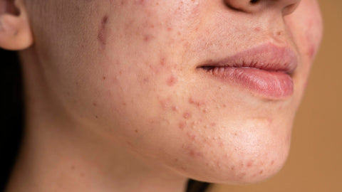 Can Collagen Cause Acne ? - Supra Vita